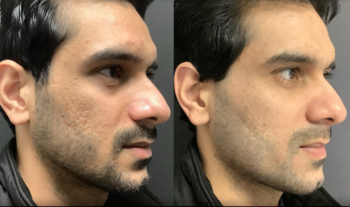 rf laser skin rejuvenation acne scars before after mississauga oakville